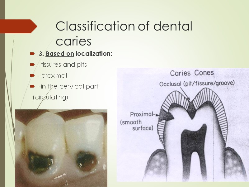 Classification of dental caries 3. Based on localization:  -fissures and pits -proximal 
